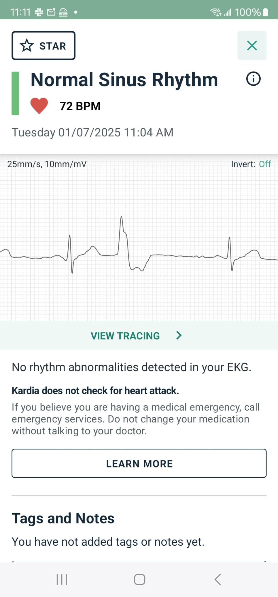 KardiaMobile 6L EKG, No Membership Required, Unlimited Recordings, HSA/FSA customer photo 2