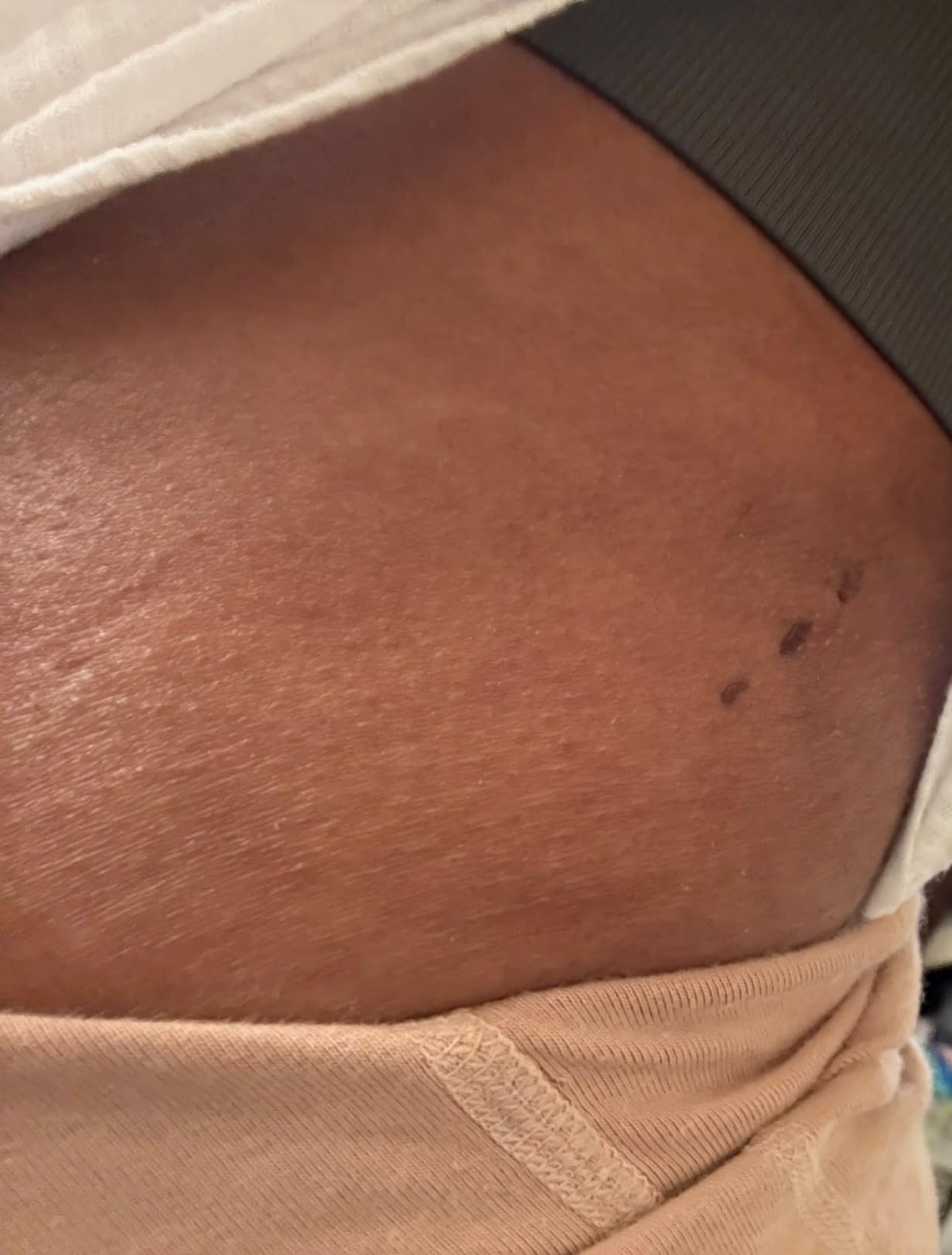 M&D Ab Lipo Foam Abdominal Board Post Surgery for Liposuction | Tabla Abdominal para Recovery Tummy Tuck customer photo 2